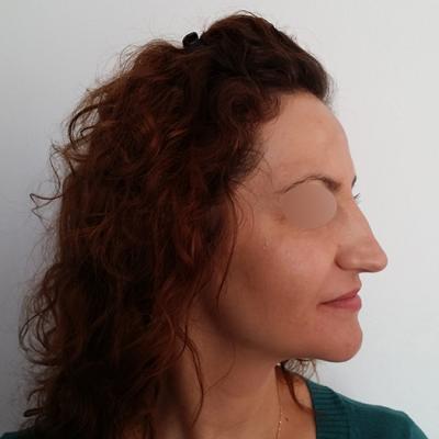 3 Inainte De Interventie