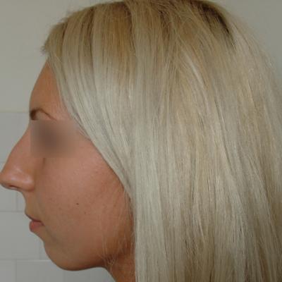 2 Inainte De Interventie