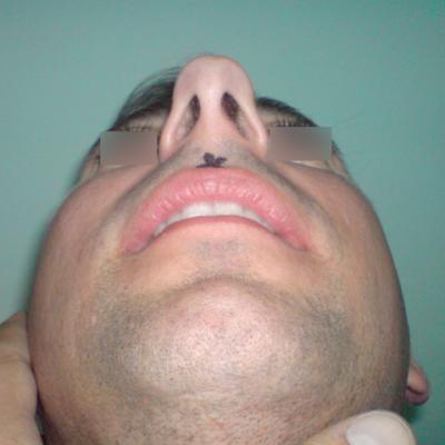 2 Inainte De Interventie