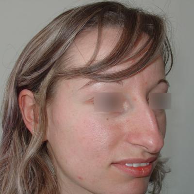 3 Inainte De Interventie