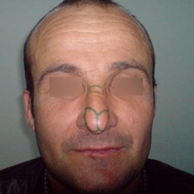 1 Inainte De Interventie