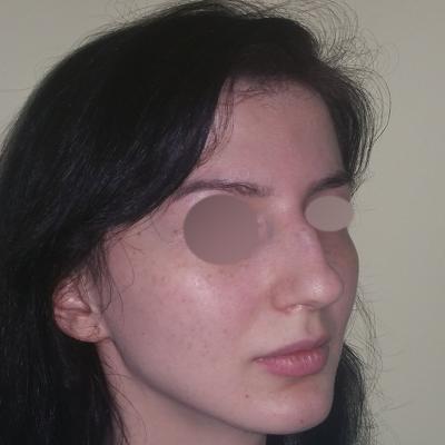 Rinoplastie - inainte de interventie 2