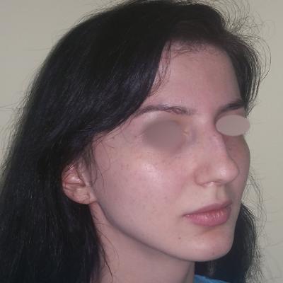 Rinoplastie -inainte de interventie 1