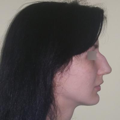 Rinoplastie - inainte de interventie 3