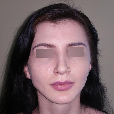 Rinoplastie - dupa interventie 4