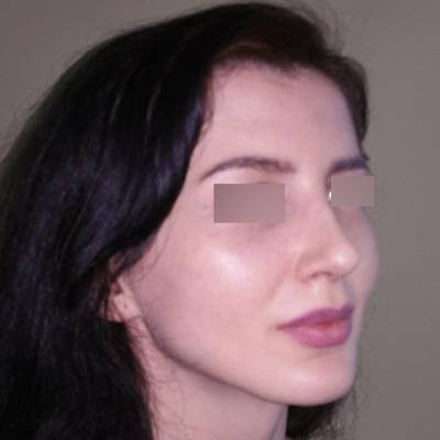 Rinoplastie - dupa interventie 5