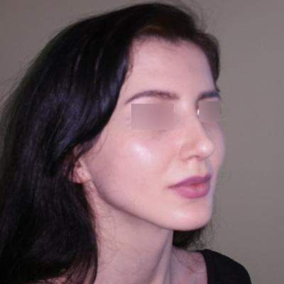 Rinoplastie -dupa interventie 2