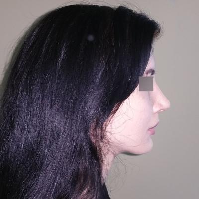 Rinoplastie -dupa interventie 1