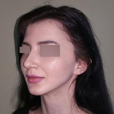 Rinoplastie -dupa interventie 3